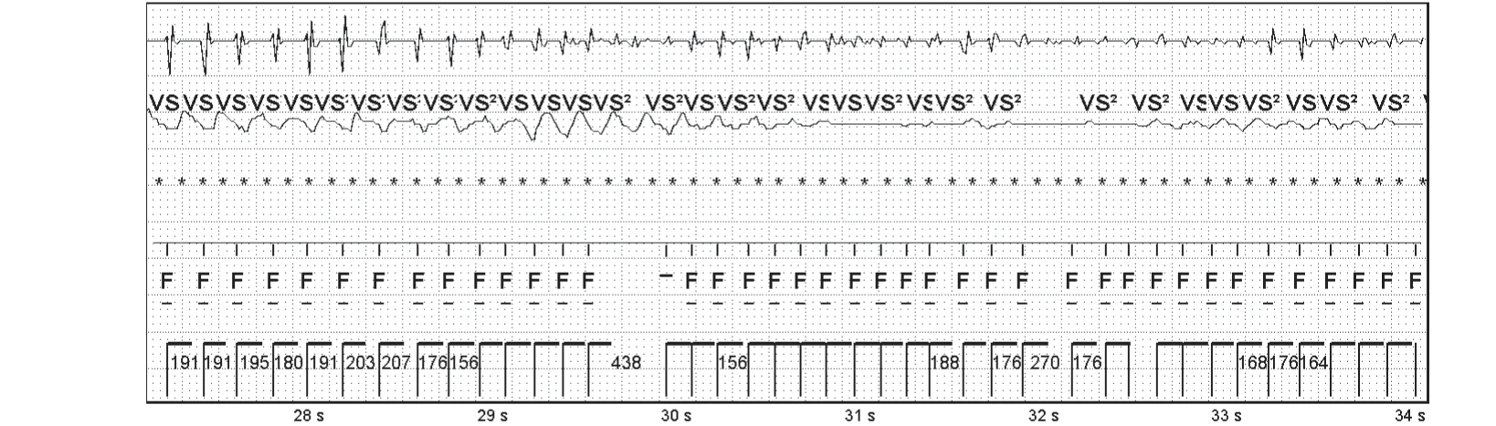 Abbott ICD electrogram, segment 5 of 6 — Operating principles, initial detection and redetection