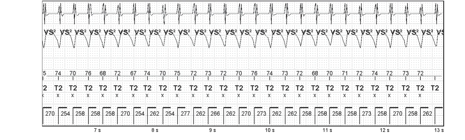 Abbott ICD electrogram, segment 2 of 3 — Competition between different detection counters