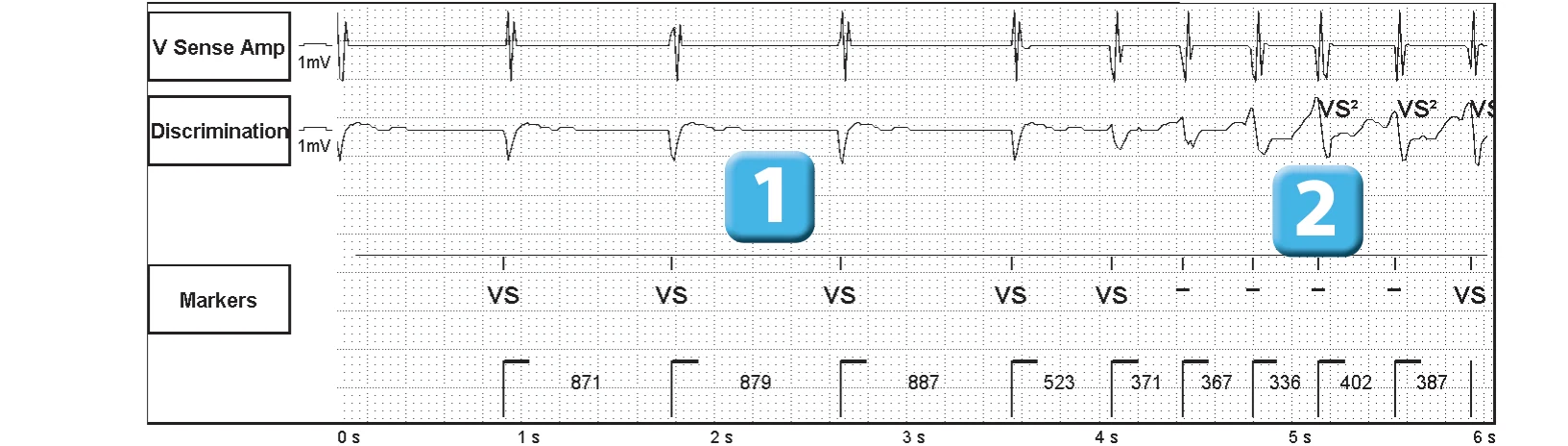 Abbott ICD electrogram, segment 1 of 5 — Competition between the different detection counters and spontaneous reduction