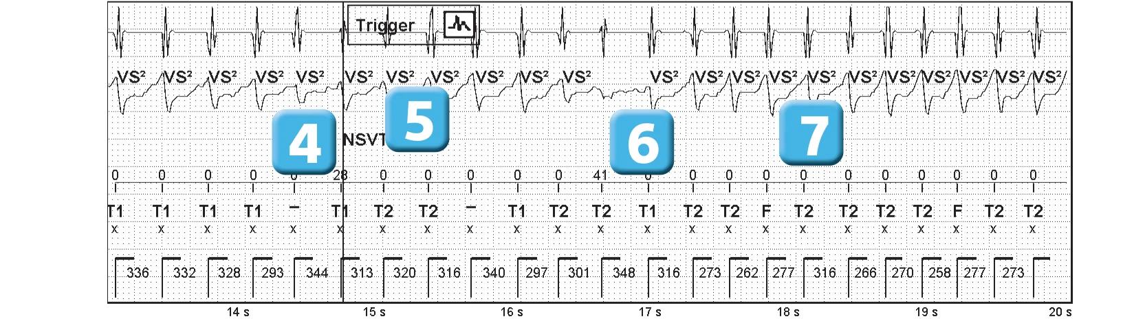Abbott ICD electrogram, segment 3 of 5 — Competition between the different detection counters and spontaneous reduction