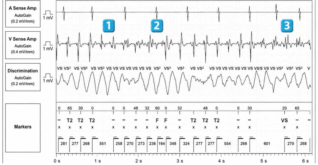 Abbott ICD electrogram, segment 1 of 4 — Classification of cycles and ventricular undersensing during an episode of VF