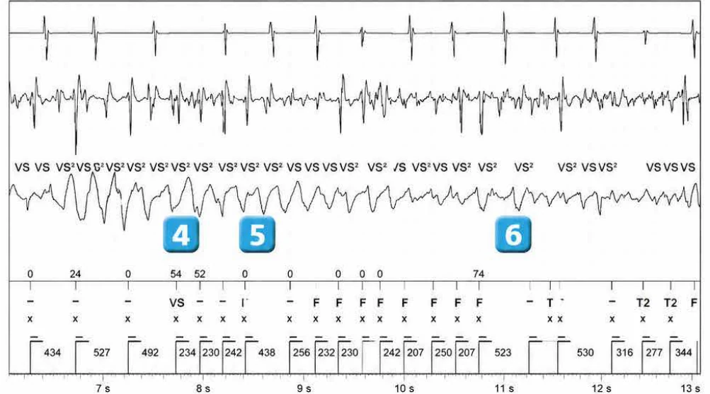 Abbott ICD electrogram, segment 2 of 4 — Classification of cycles and ventricular undersensing during an episode of VF