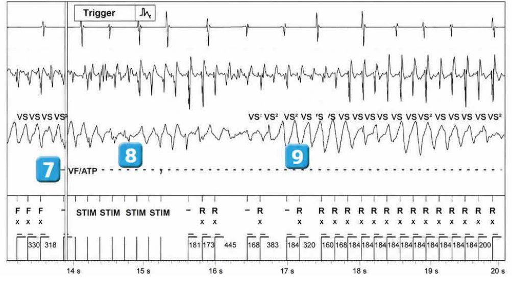 Abbott ICD electrogram, segment 3 of 4 — Classification of cycles and ventricular undersensing during an episode of VF