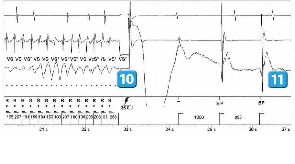 Abbott ICD electrogram, segment 4 of 4 — Classification of cycles and ventricular undersensing during an episode of VF