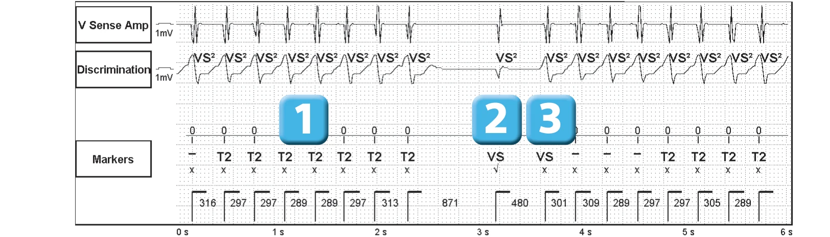 Abbott ICD electrogram, segment 1 of 3 — Sinus return counter and non-sustained ventricular tachycardias