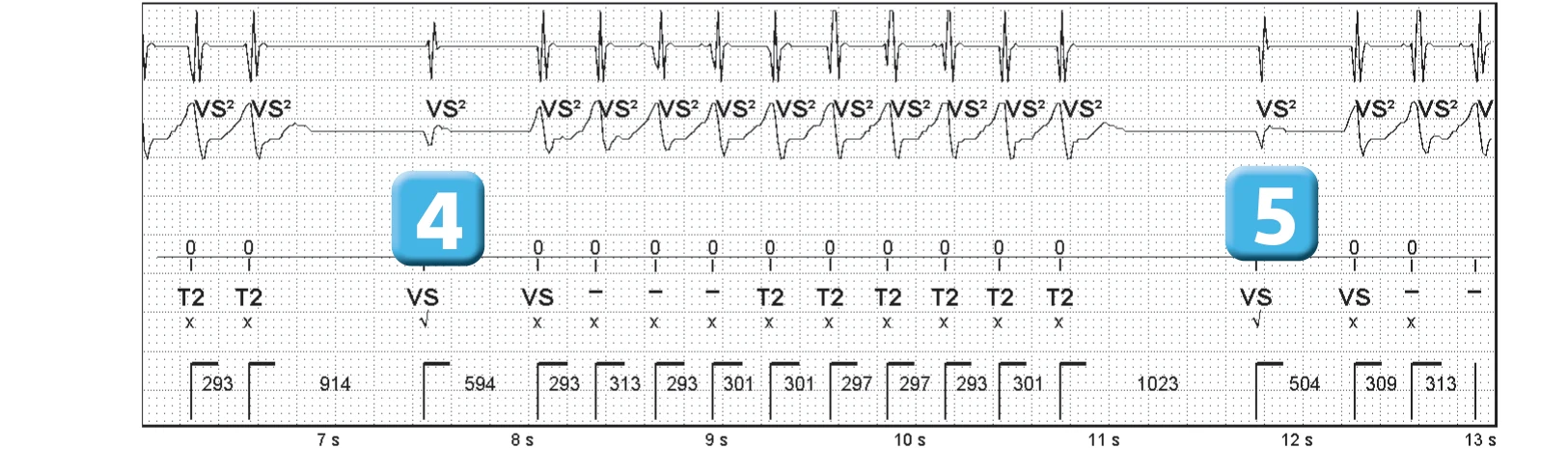 Abbott ICD electrogram, segment 2 of 3 — Sinus return counter and non-sustained ventricular tachycardias