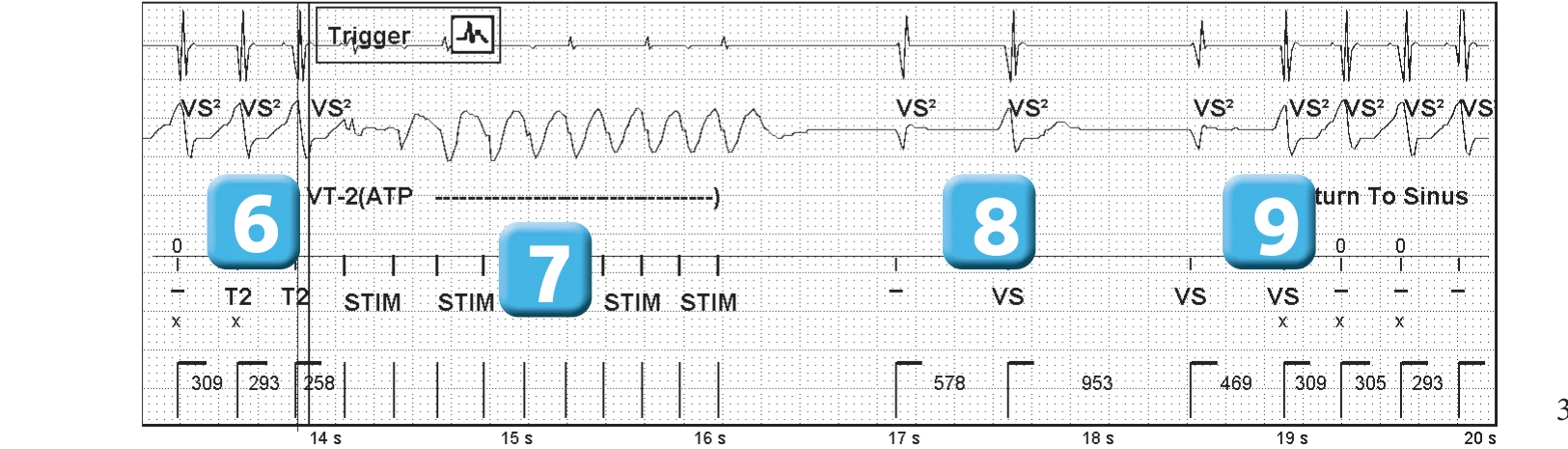 Abbott ICD electrogram, segment 3 of 3 — Sinus return counter and non-sustained ventricular tachycardias