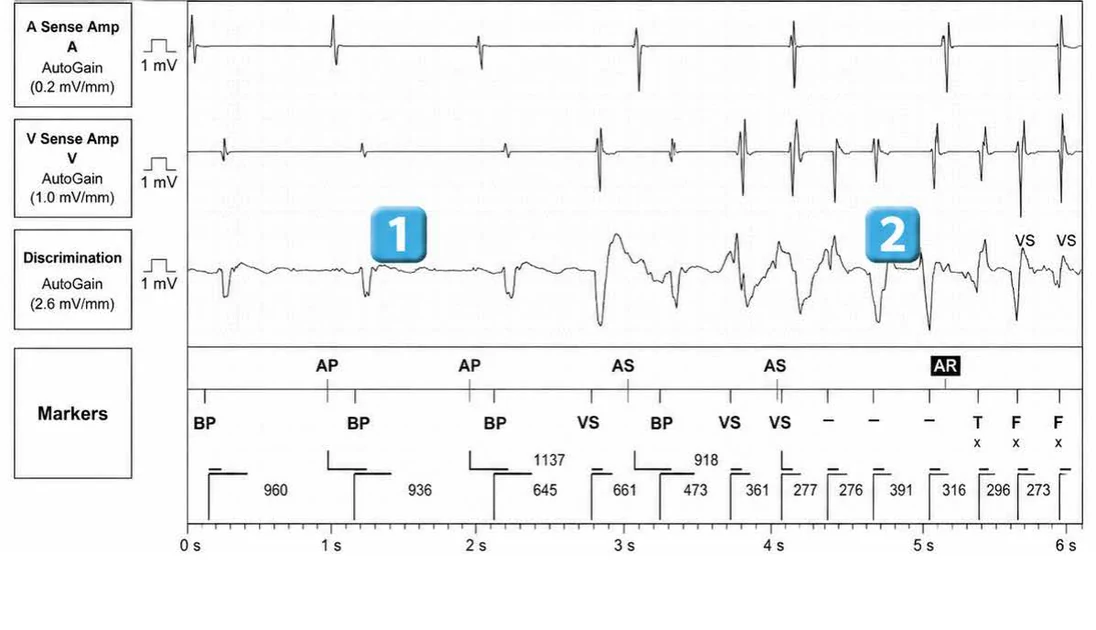 Abbott ICD electrogram, segment 1 of 7 — Redetection counter after acceleration of VT in the VF zone