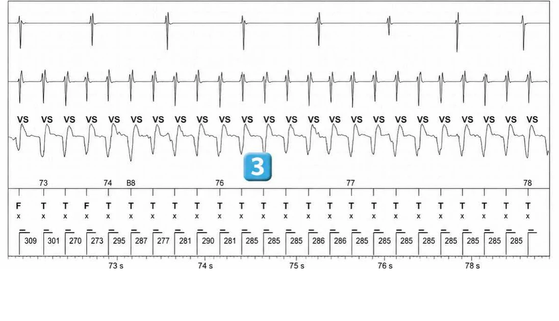 Abbott ICD electrogram, segment 2 of 7 — Redetection counter after acceleration of VT in the VF zone