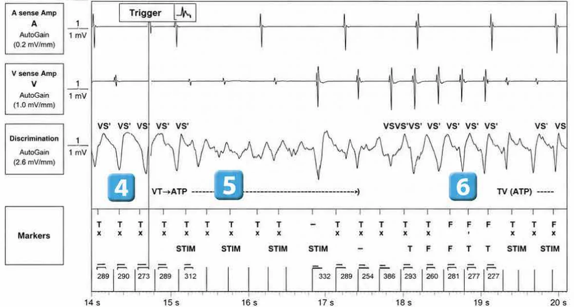 Abbott ICD electrogram, segment 3 of 7 — Redetection counter after acceleration of VT in the VF zone