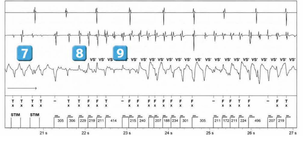Abbott ICD electrogram, segment 4 of 7 — Redetection counter after acceleration of VT in the VF zone