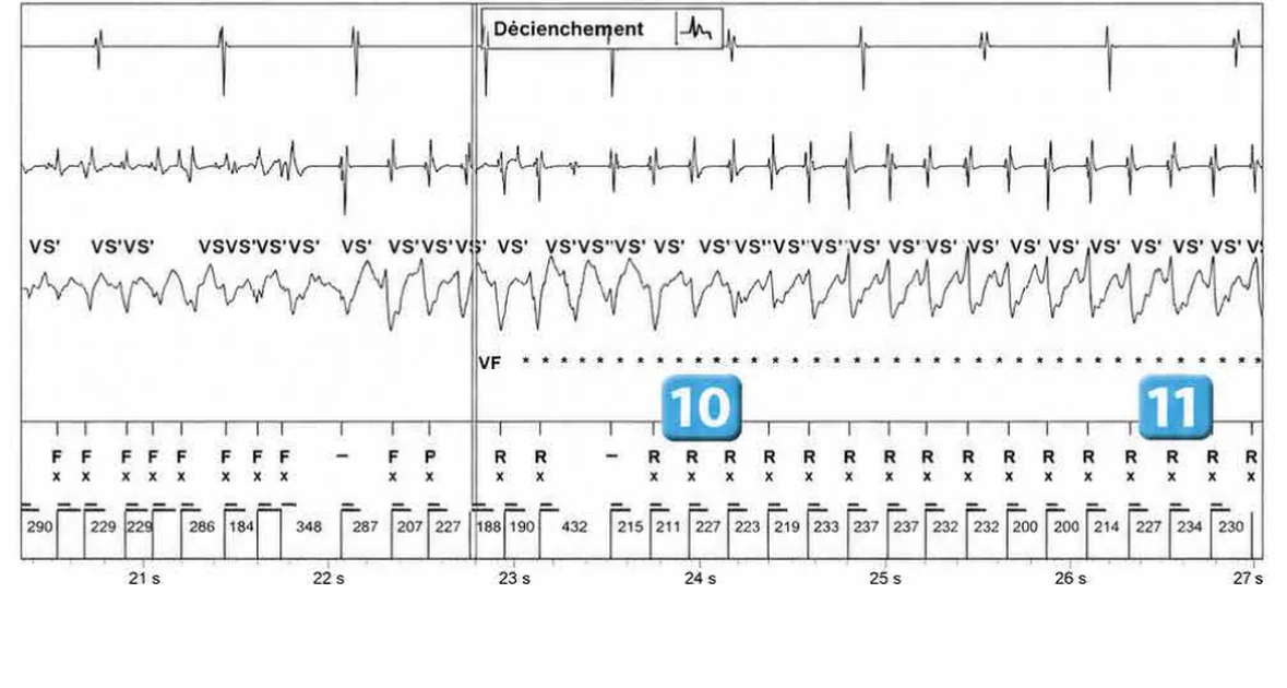Abbott ICD electrogram, segment 5 of 7 — Redetection counter after acceleration of VT in the VF zone
