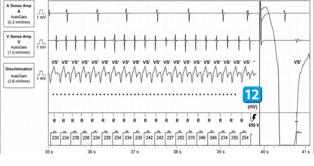 Abbott ICD electrogram, segment 6 of 7 — Redetection counter after acceleration of VT in the VF zone