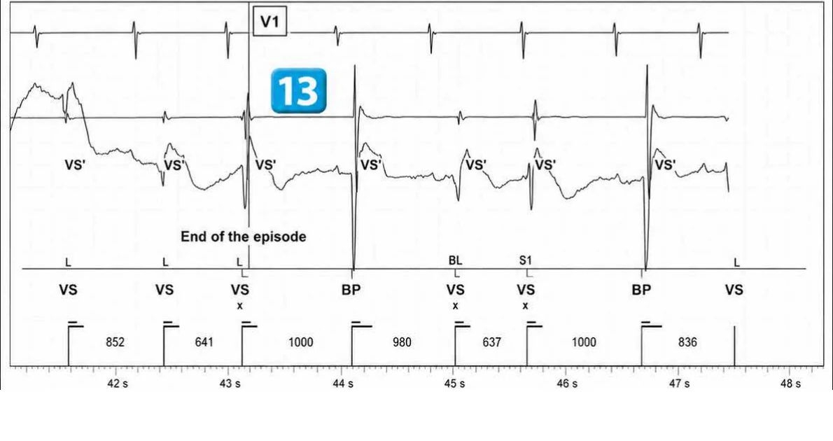 Abbott ICD electrogram, segment 7 of 7 — Redetection counter after acceleration of VT in the VF zone