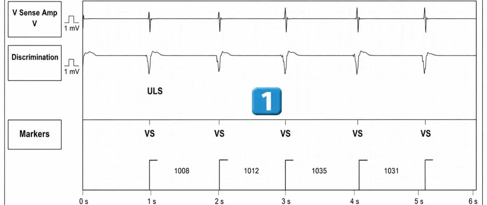 Abbott ICD electrogram, segment 1 of 3 — New recommendations and number cycles in initial detection