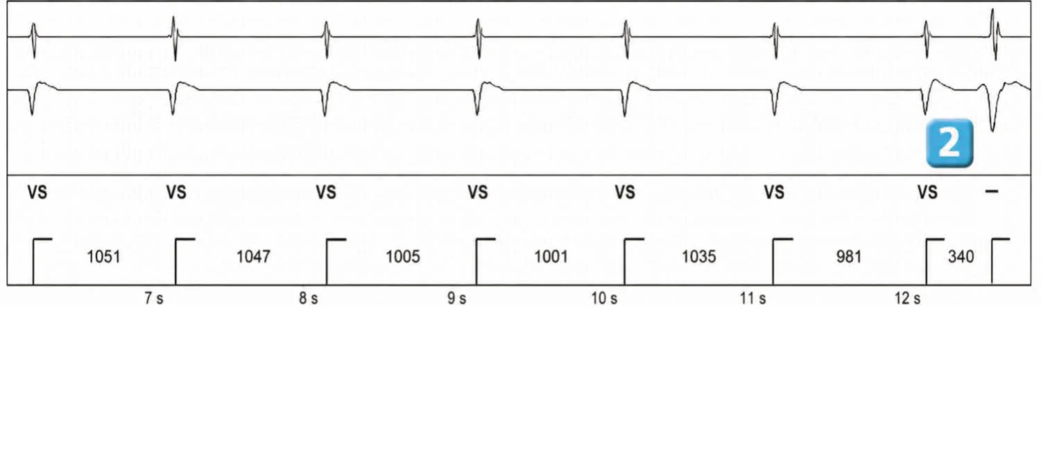 Abbott ICD electrogram, segment 2 of 3 — New recommendations and number cycles in initial detection