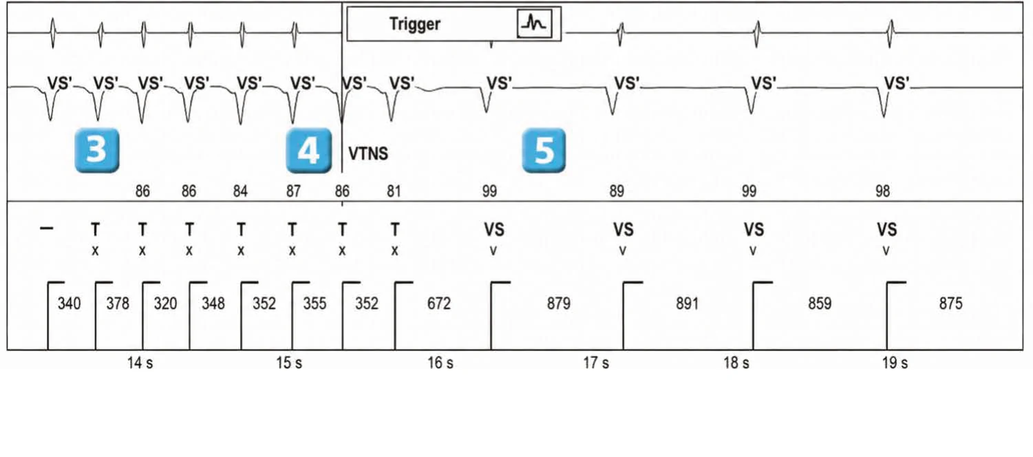 Abbott ICD electrogram, segment 3 of 3 — New recommendations and number cycles in initial detection