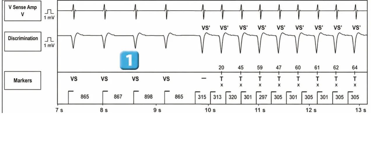 Abbott ICD electrogram, segment 2 of 4 — New recommendations and number cycles in initial detection