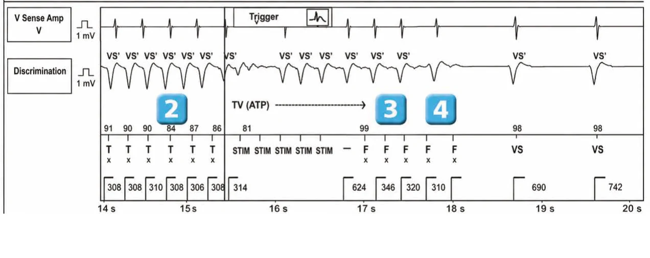 Abbott ICD electrogram, segment 3 of 4 — New recommendations and number cycles in initial detection