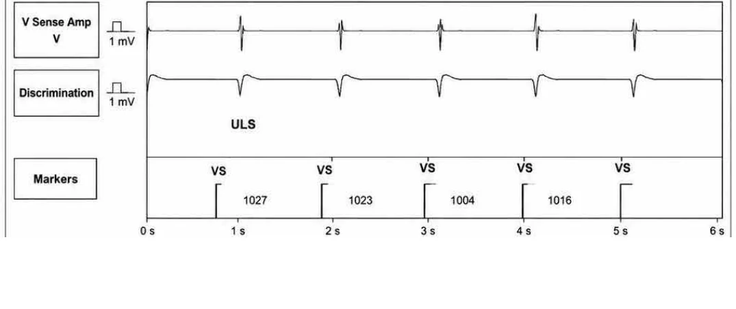 Abbott ICD electrogram, segment 1 of 5 — New recommendations and number cycles in initial detection