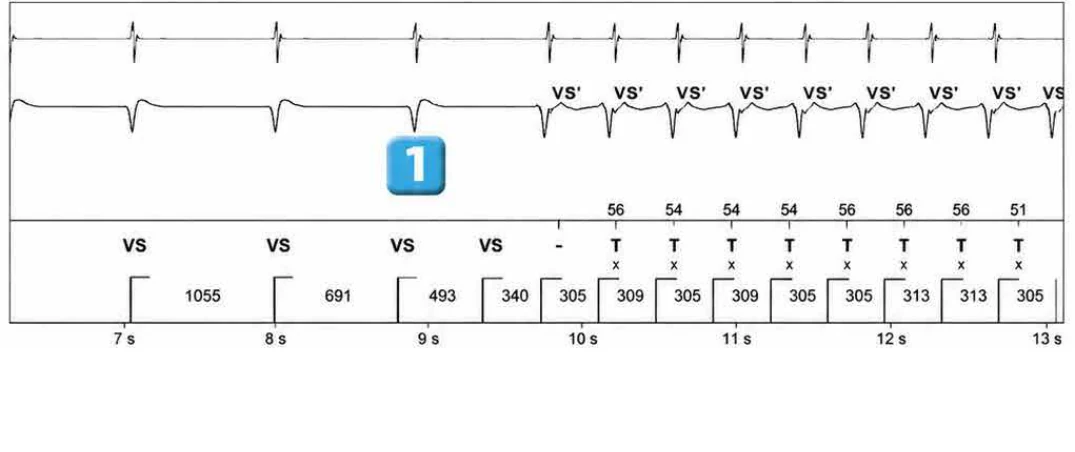Abbott ICD electrogram, segment 2 of 5 — New recommendations and number cycles in initial detection