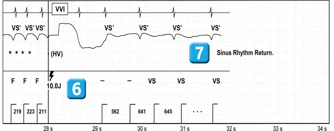 Abbott ICD electrogram, segment 5 of 5 — New recommendations and number cycles in initial detection