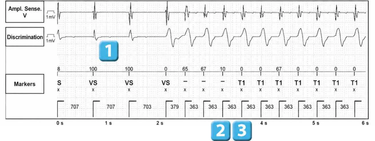 Abbott ICD electrogram, segment 1 of 3 — VT episode and single chamber discrimination