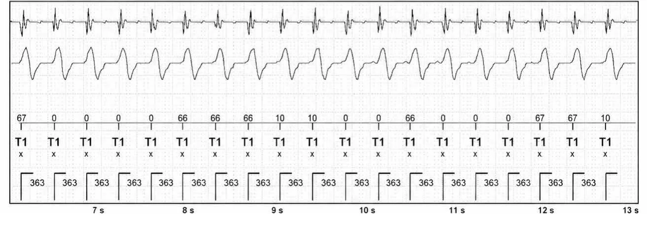 Abbott ICD electrogram, segment 2 of 3 — VT episode and single chamber discrimination