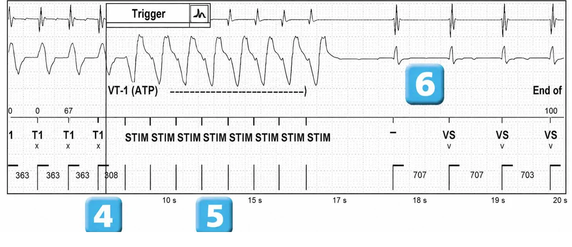Abbott ICD electrogram, segment 3 of 3 — VT episode and single chamber discrimination