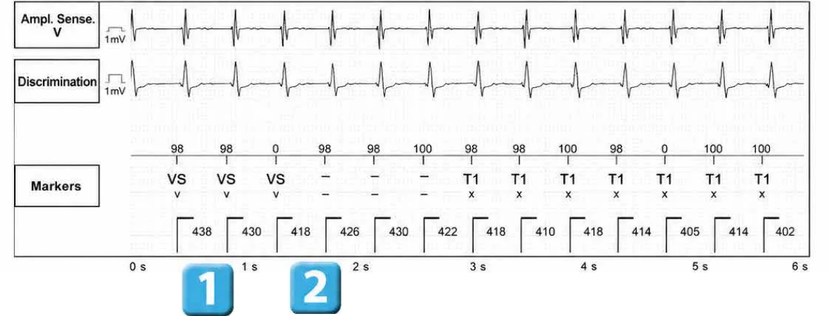 Abbott ICD electrogram, segment 1 of 13 — Episode of sinus tachycardia and single-chamber discrimination