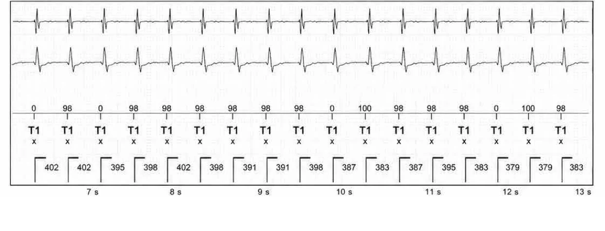 Abbott ICD electrogram, segment 2 of 13 — Episode of sinus tachycardia and single-chamber discrimination