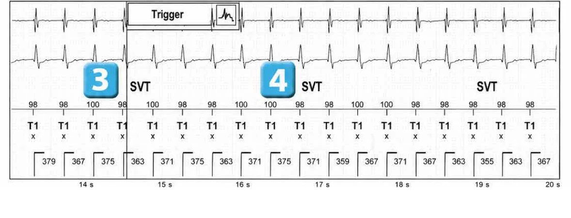 Abbott ICD electrogram, segment 3 of 13 — Episode of sinus tachycardia and single-chamber discrimination