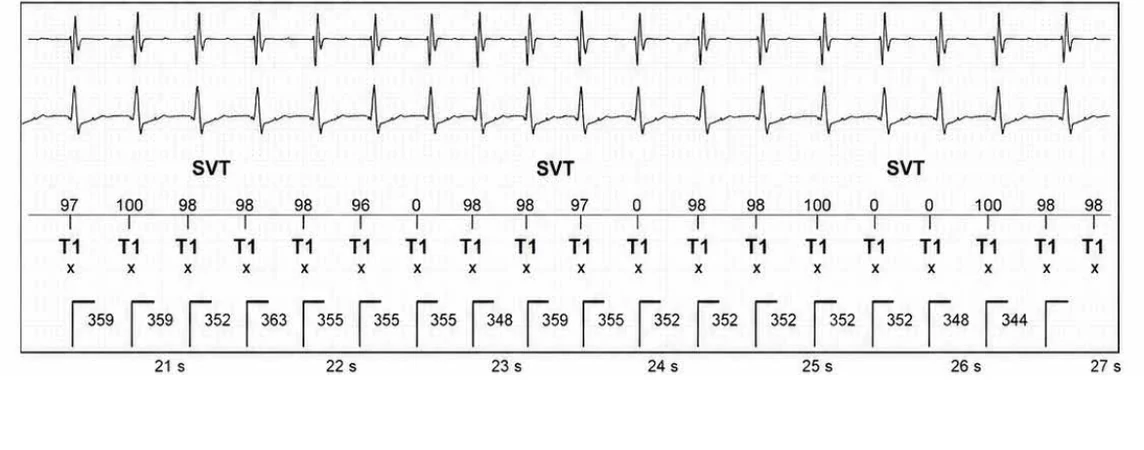 Abbott ICD electrogram, segment 4 of 13 — Episode of sinus tachycardia and single-chamber discrimination