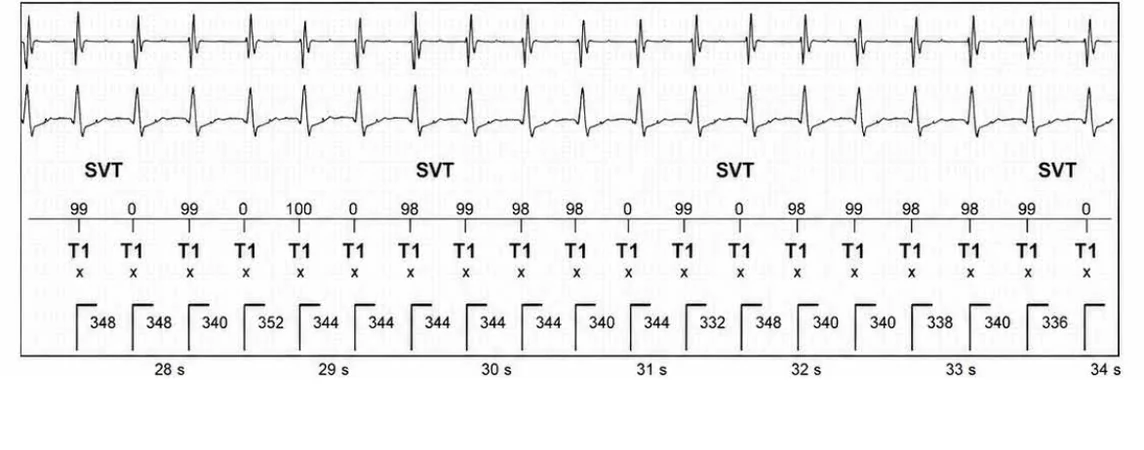 Abbott ICD electrogram, segment 5 of 13 — Episode of sinus tachycardia and single-chamber discrimination