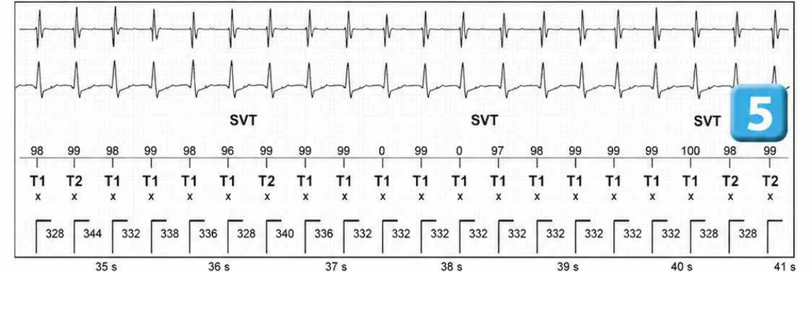 Abbott ICD electrogram, segment 6 of 13 — Episode of sinus tachycardia and single-chamber discrimination