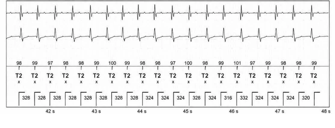 Abbott ICD electrogram, segment 7 of 13 — Episode of sinus tachycardia and single-chamber discrimination
