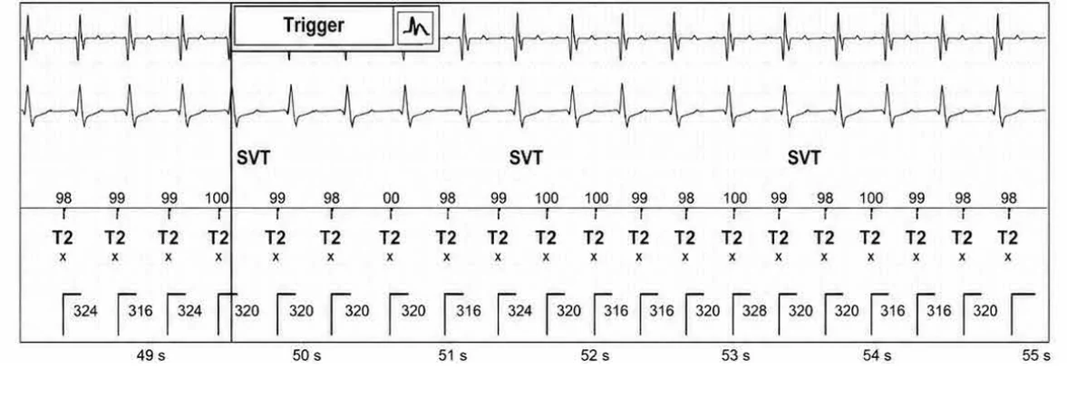 Abbott ICD electrogram, segment 8 of 13 — Episode of sinus tachycardia and single-chamber discrimination