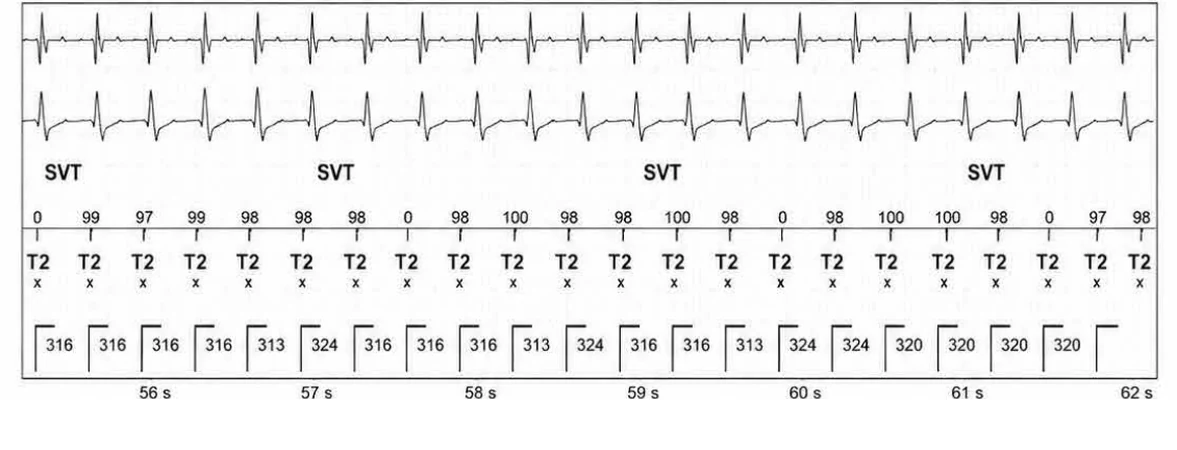 Abbott ICD electrogram, segment 9 of 13 — Episode of sinus tachycardia and single-chamber discrimination