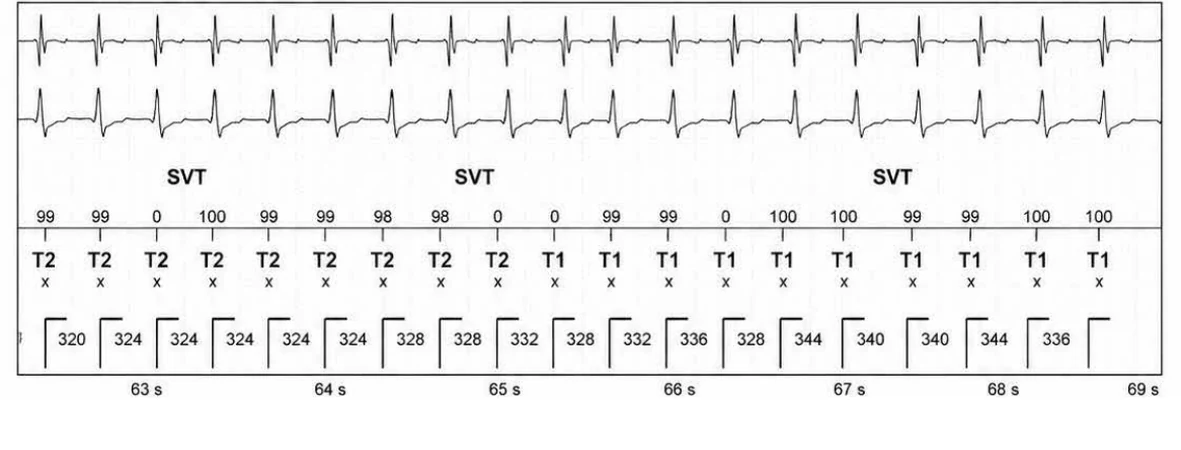 Abbott ICD electrogram, segment 10 of 13 — Episode of sinus tachycardia and single-chamber discrimination