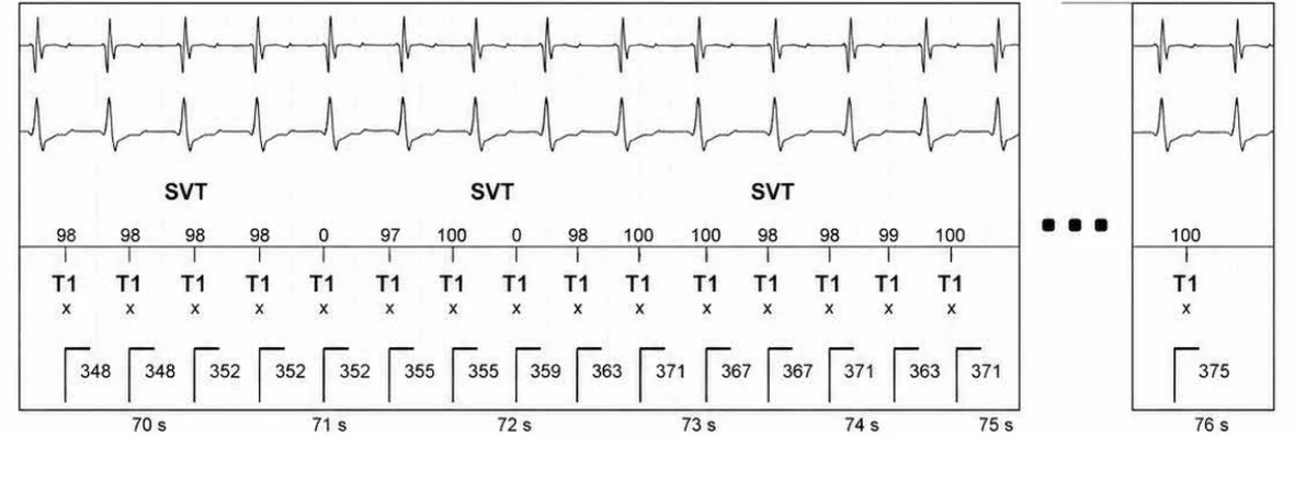 Abbott ICD electrogram, segment 11 of 13 — Episode of sinus tachycardia and single-chamber discrimination