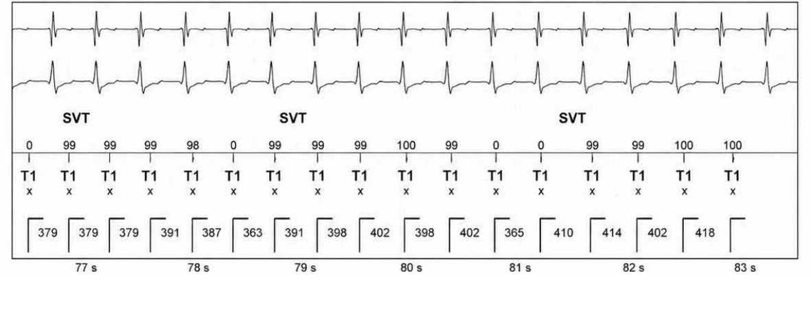 Abbott ICD electrogram, segment 12 of 13 — Episode of sinus tachycardia and single-chamber discrimination