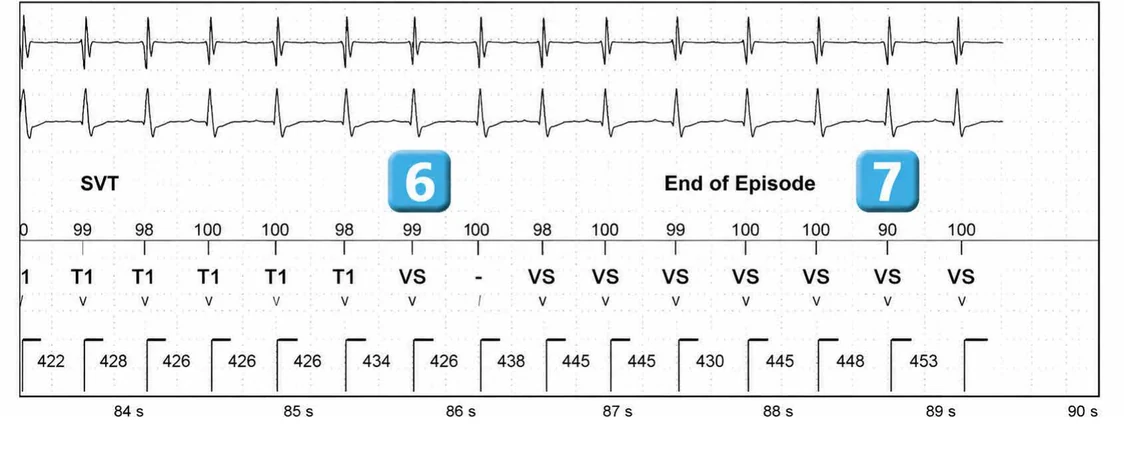 Abbott ICD electrogram, segment 13 of 13 — Episode of sinus tachycardia and single-chamber discrimination