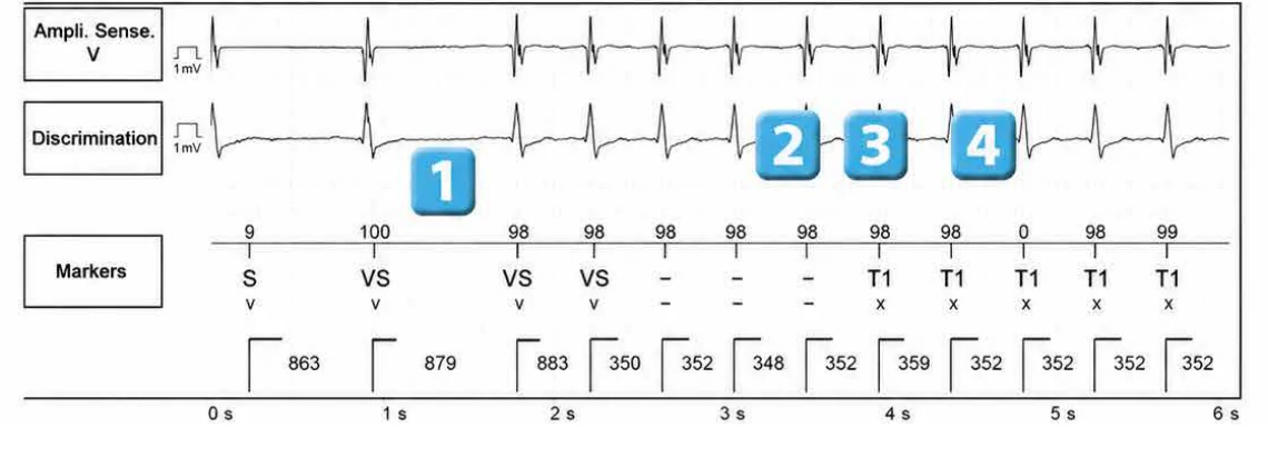 Abbott ICD electrogram, segment 1 of 5 — Atrial tachycardia and single-chamber discrimination