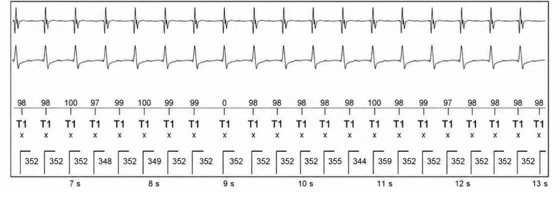 Abbott ICD electrogram, segment 2 of 5 — Atrial tachycardia and single-chamber discrimination
