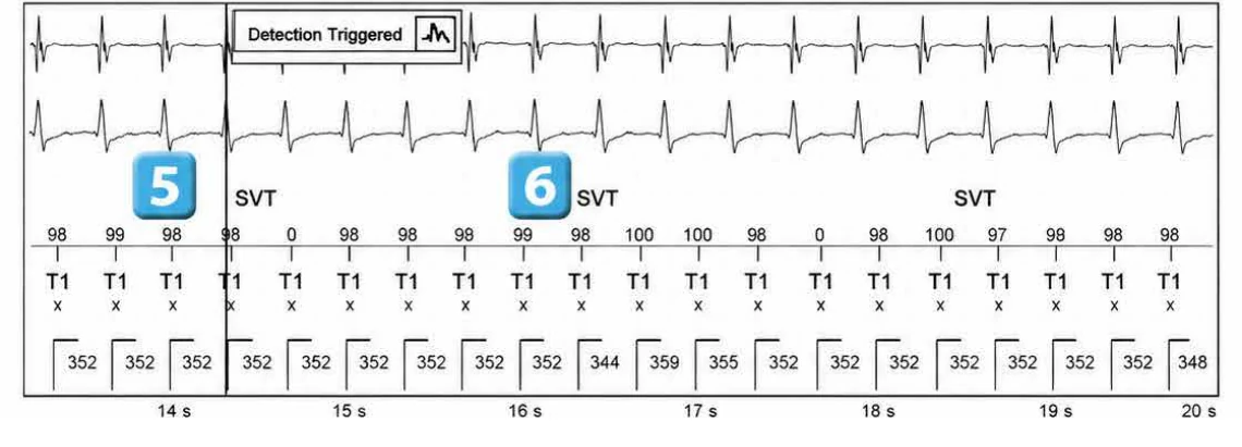 Abbott ICD electrogram, segment 3 of 5 — Atrial tachycardia and single-chamber discrimination