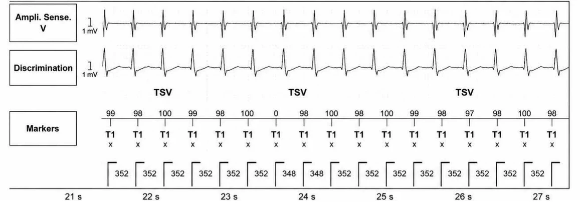 Abbott ICD electrogram, segment 4 of 5 — Atrial tachycardia and single-chamber discrimination