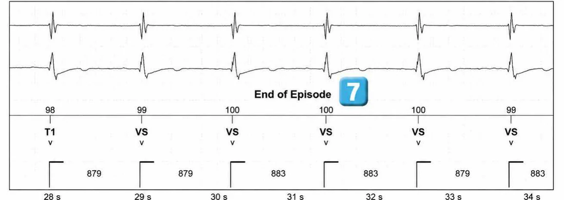 Abbott ICD electrogram, segment 5 of 5 — Atrial tachycardia and single-chamber discrimination