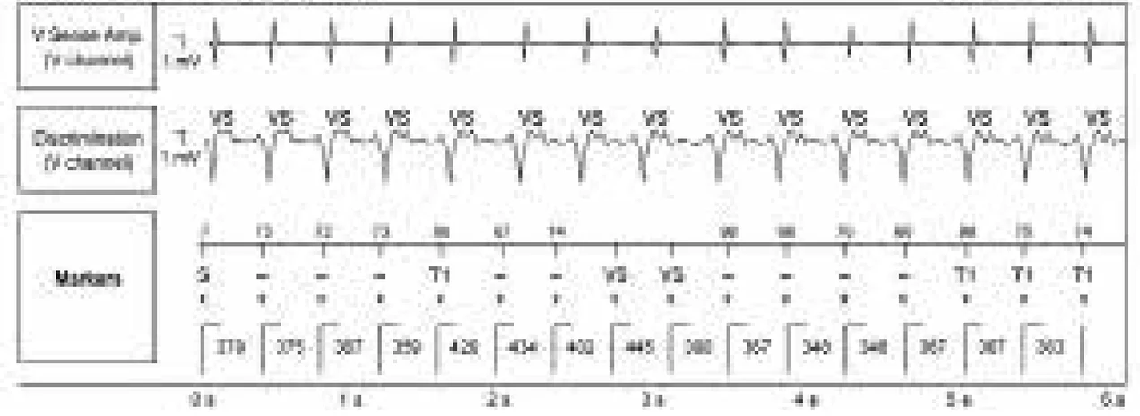 Abbott ICD electrogram, segment 1 of 5 — Simple chamber discrimination and discriminant association