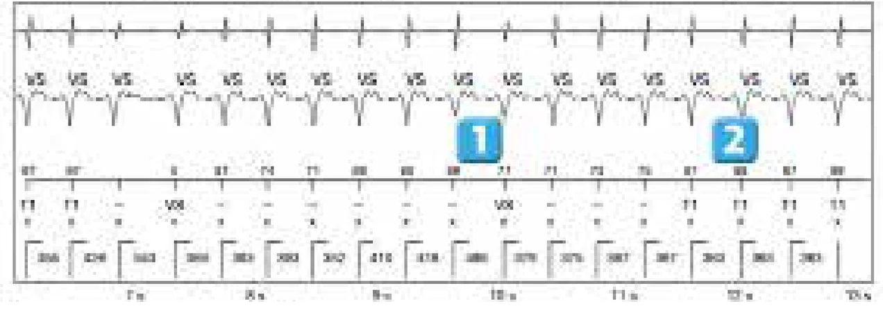 Abbott ICD electrogram, segment 2 of 5 — Simple chamber discrimination and discriminant association