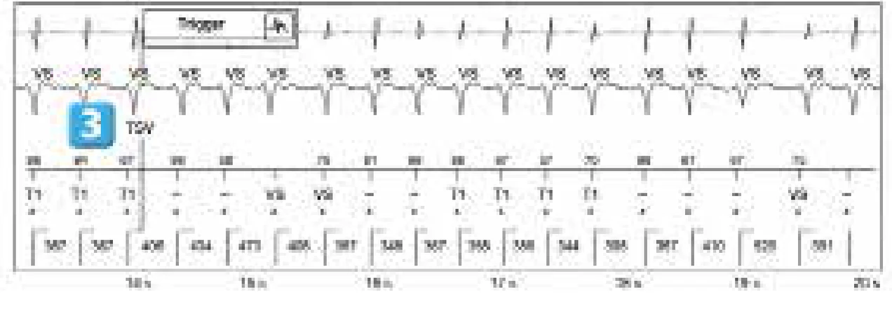 Abbott ICD electrogram, segment 3 of 5 — Simple chamber discrimination and discriminant association